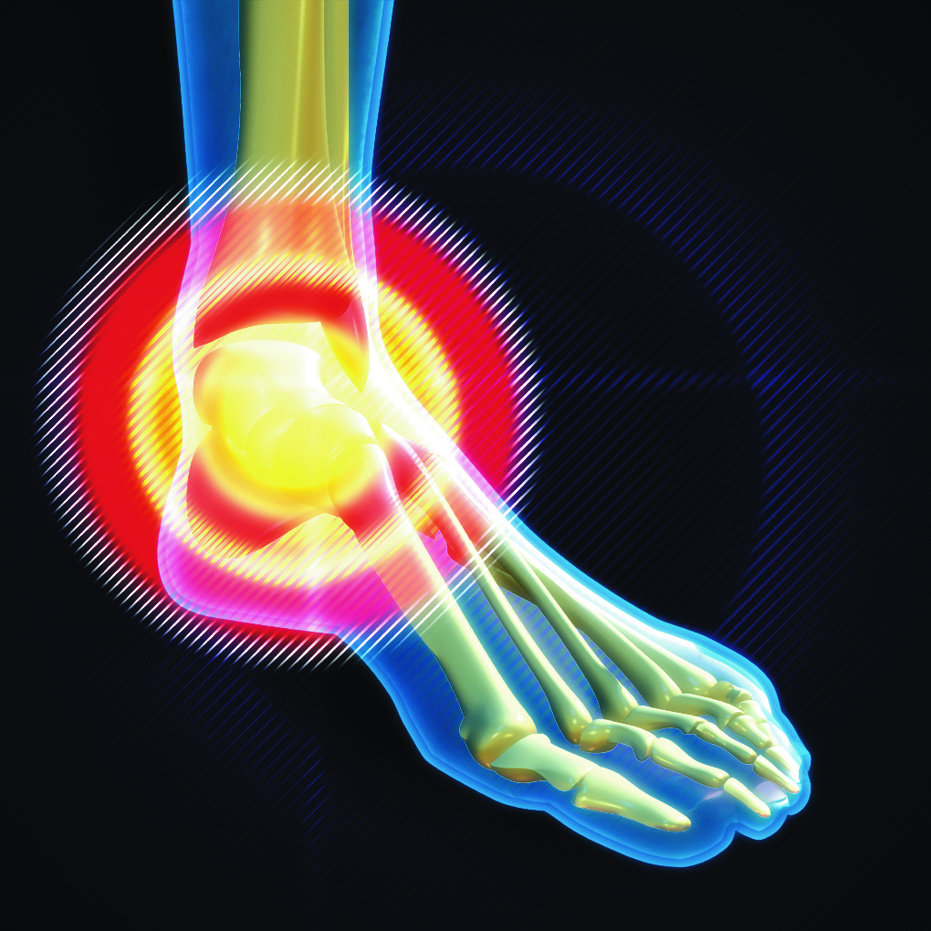 New treatment shows promise for Achilles tendonitis and other chronic tendon injuries